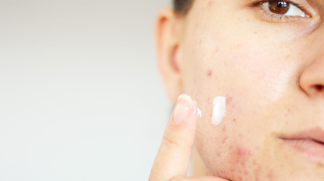 woman with acne applying cream to her face