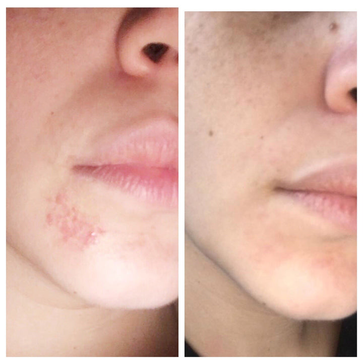 Before and after photo of face from tamamu oil benefits